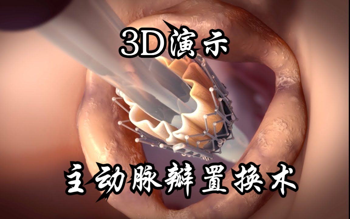 3D演示:主动脉瓣置换术哔哩哔哩bilibili