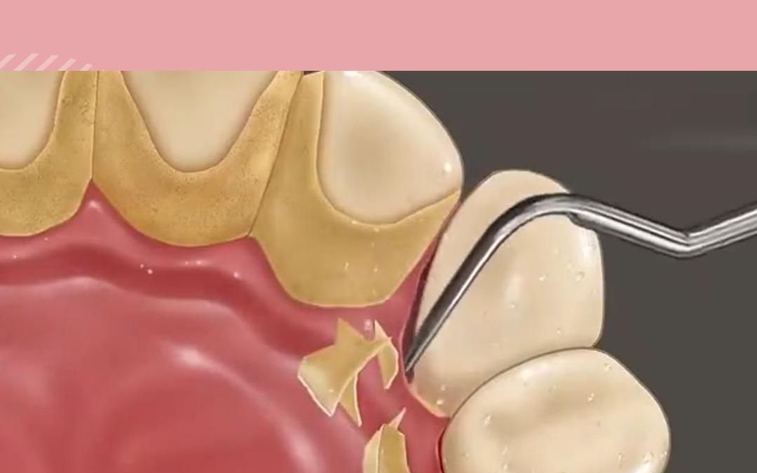 动画演示 清理牙结石过程