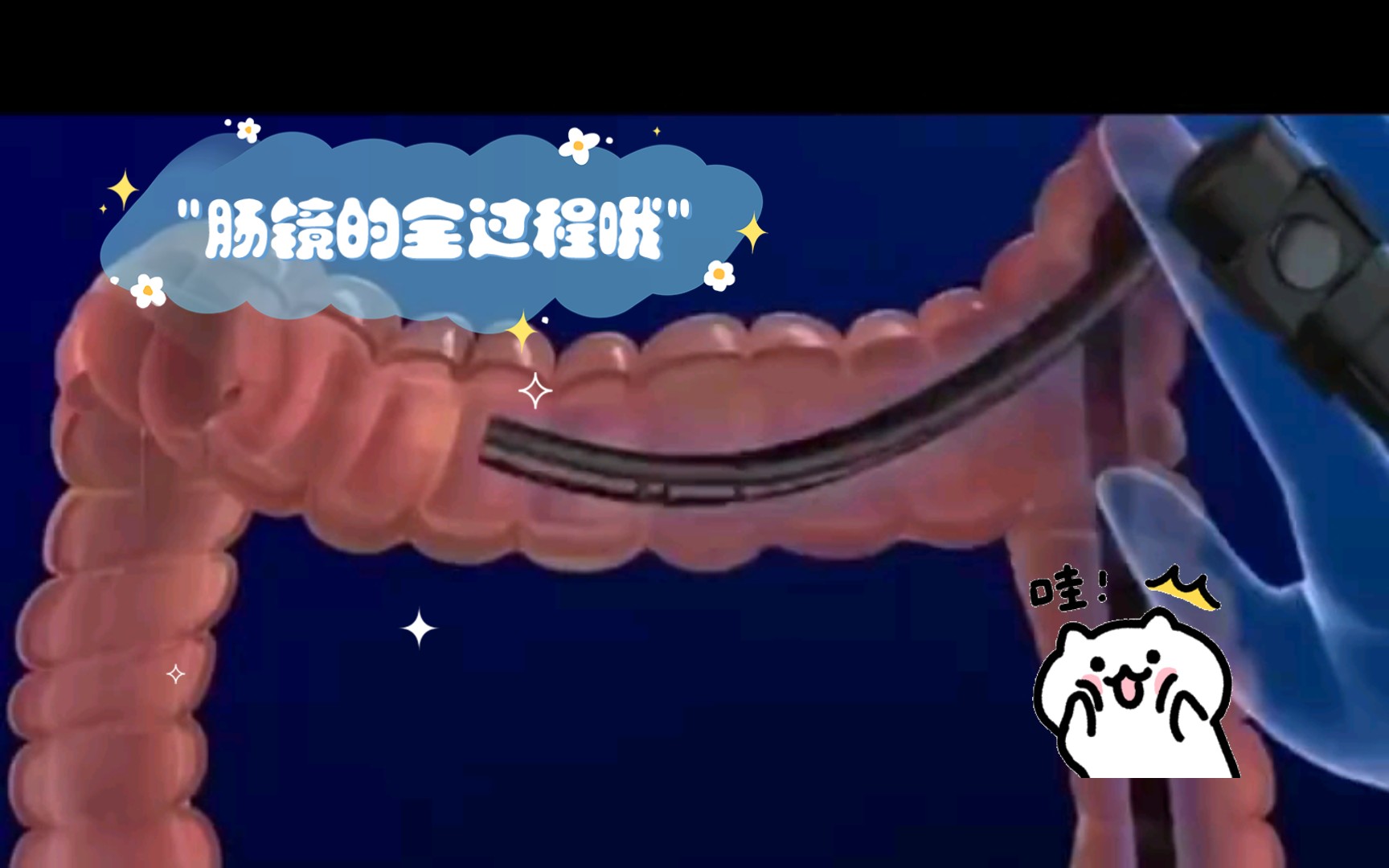 肠镜的全过程哦哔哩哔哩bilibili