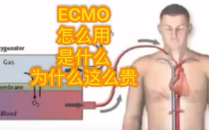 ECMO是什么怎么用为什么用一次这么贵哔哩哔哩bilibili