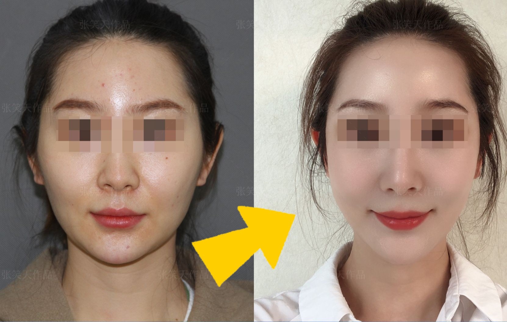 颧骨内推 下颌角截骨  去外板,漂亮多了_哔哩哔哩_bilibili