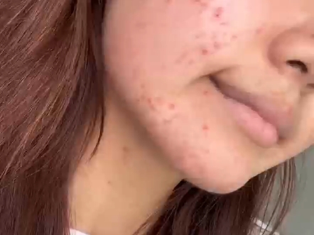 慢慢的 我的自信也找回来了#祛痘#痘痘女孩逆袭