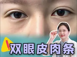 Tải video: 埋线后形成的肉条感，还能修吗❓❗️