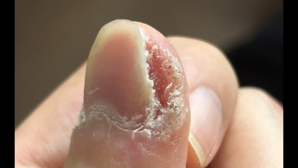 严重甲周疣 恭喜毕业啦🎉🎉