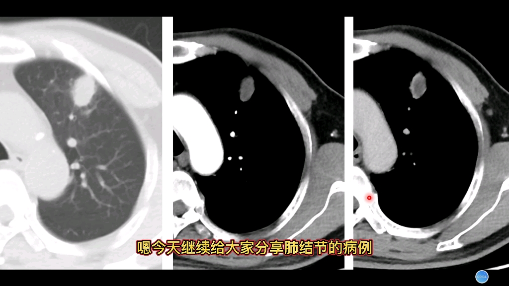 良性肺结节病例分享:CT出现这个典型特征,多半是良性结节!哔哩哔哩bilibili