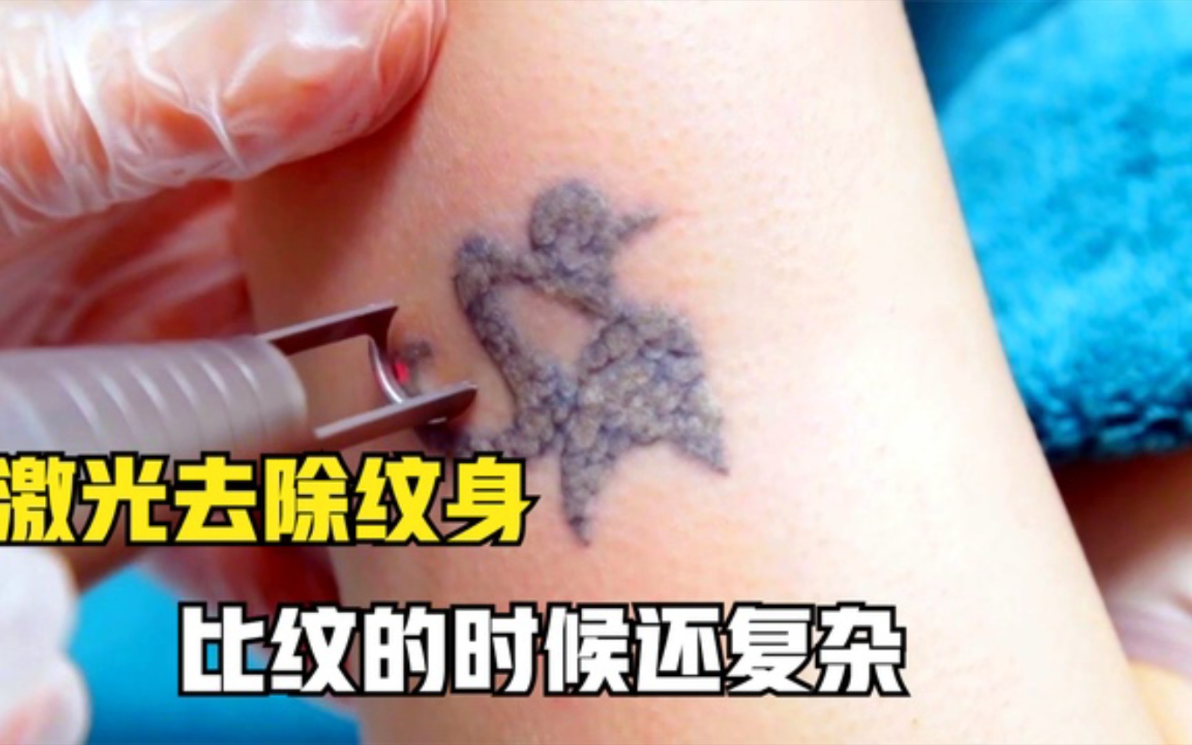 激光是怎么去除纹身的?过程比纹的时候还复杂,看着就觉得疼!