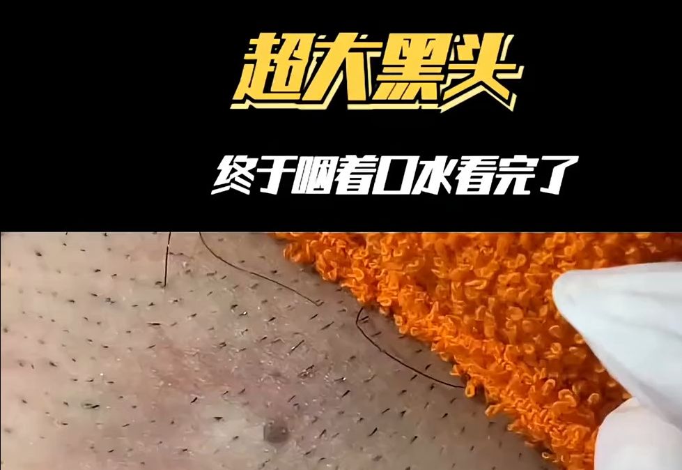 超大黑头,看看里面是什么