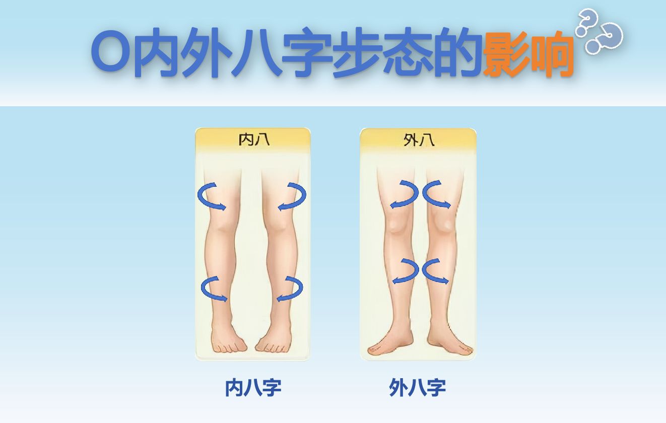 内外八字步态的影响哔哩哔哩bilibili