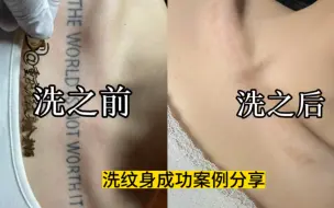 Tải video: 洗跟没洗还是有区别的 你最担心的问题“ 留疤”怎么办 现在看完你还担心吗？