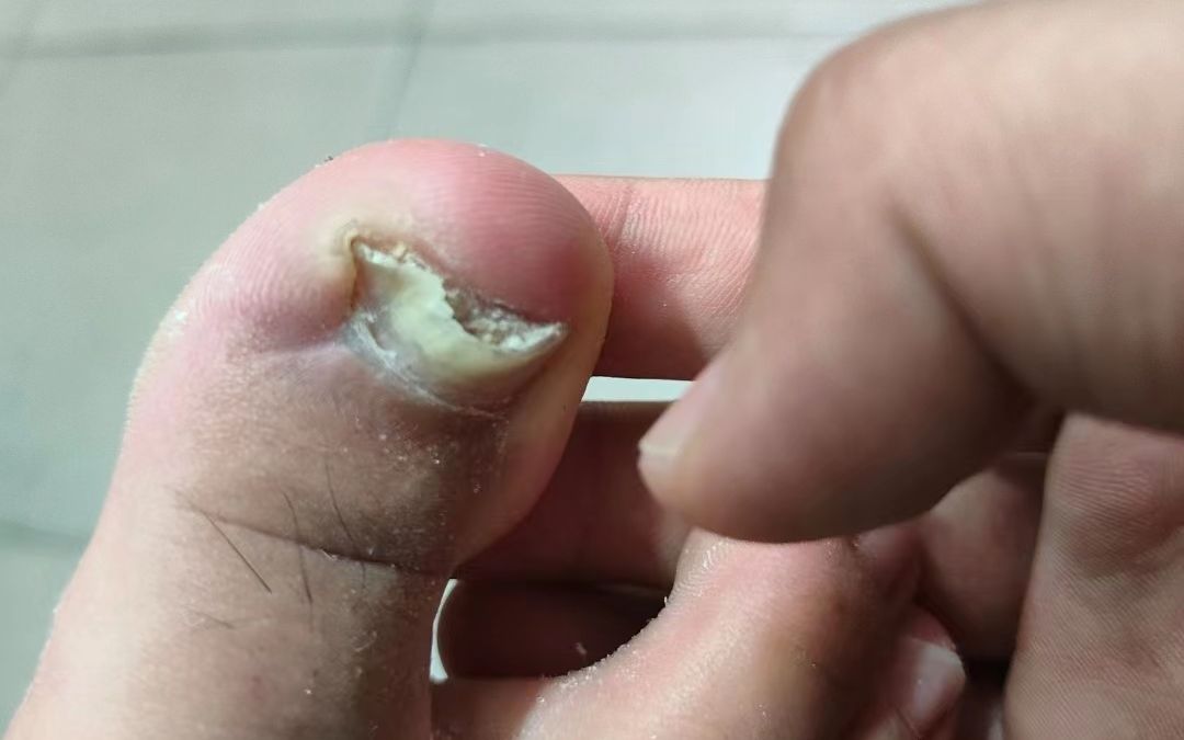 自用去灰指甲妙招分享!30天泛黄增厚坏甲自己掉!不多花冤枉钱!