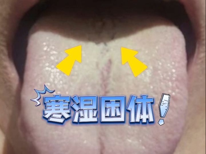 舌診分析:遇到這種舌頭,溼熱只是假象,昇陽才是關鍵!