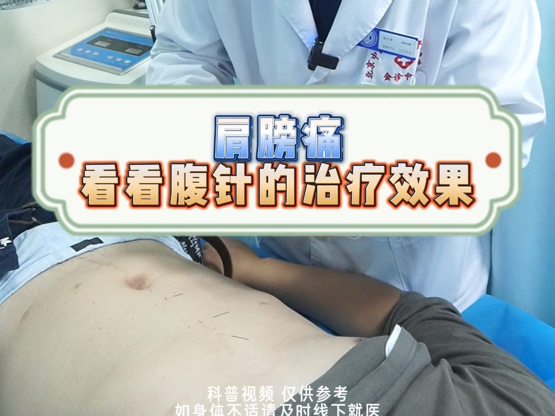 肩膀痛看看腹针的治疗效果哔哩哔哩bilibili