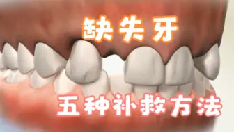 侧切牙缺失怎么办,牙齿缺失五种补救方法，做完牙齿真的太好看了