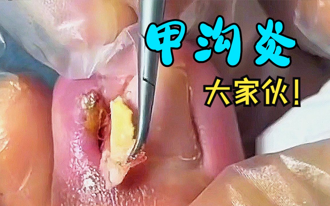 甲沟炎,藏的好深的大家伙 !哔哩哔哩bilibili