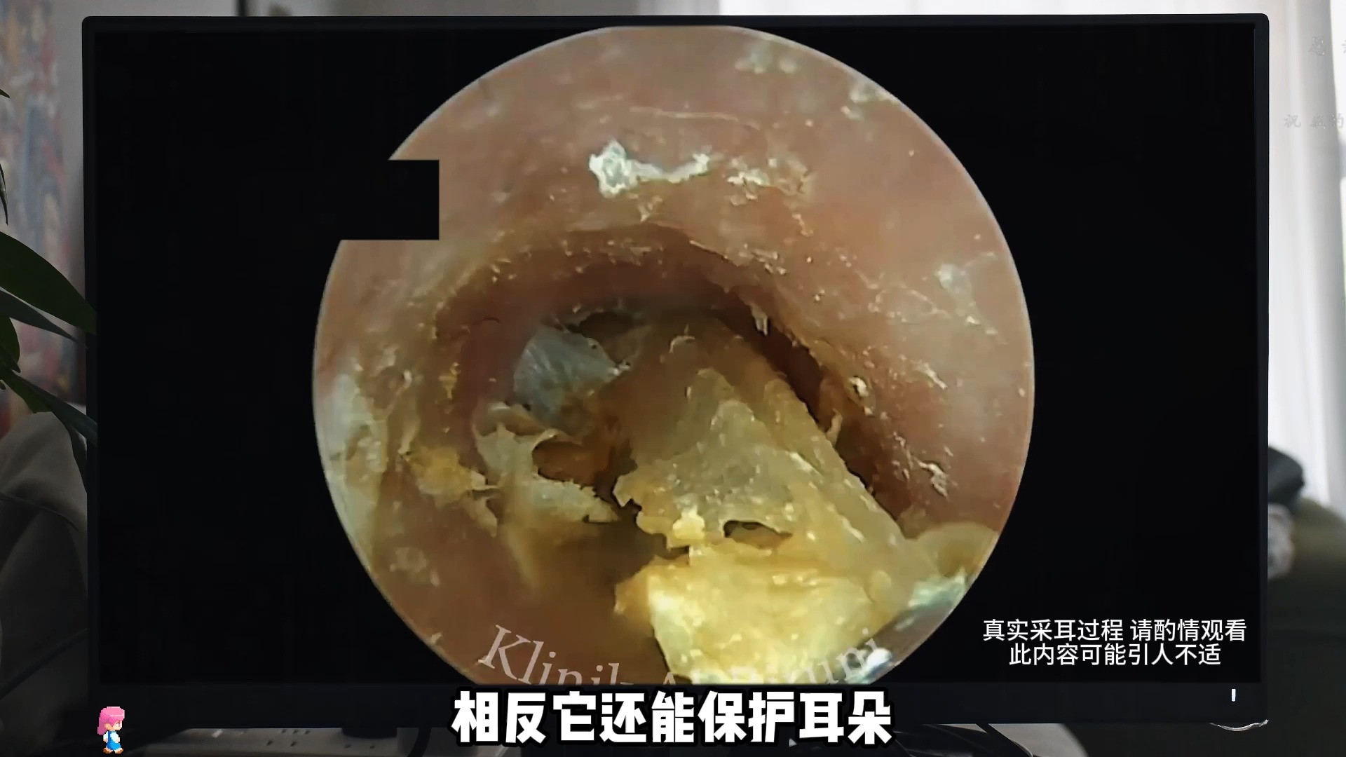 掏耳朵为什么会咳嗽