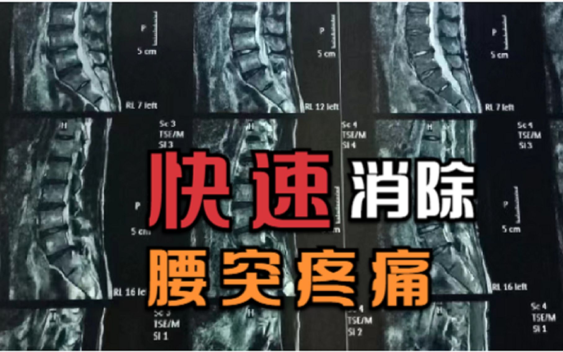 这些腰椎间盘突出“特效药”终于被曝光了!腰突患者千万别错过!哔哩哔哩bilibili