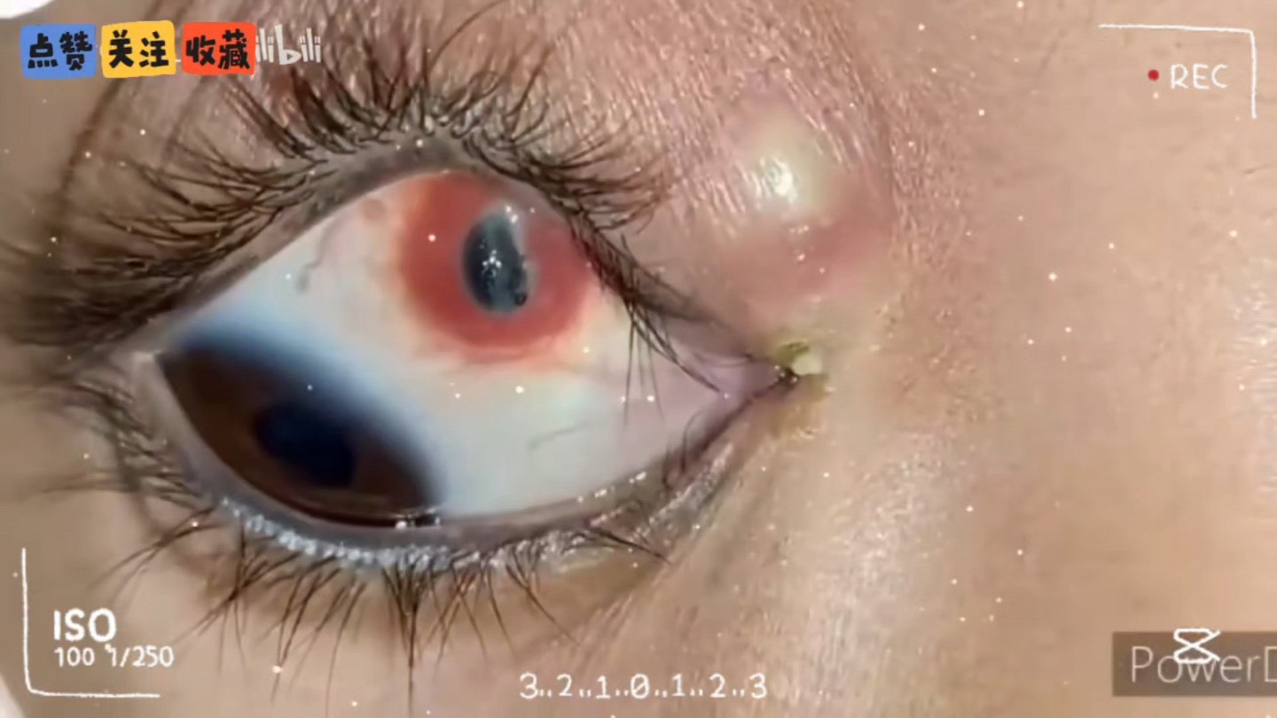 眼睛里长了颗痘痘