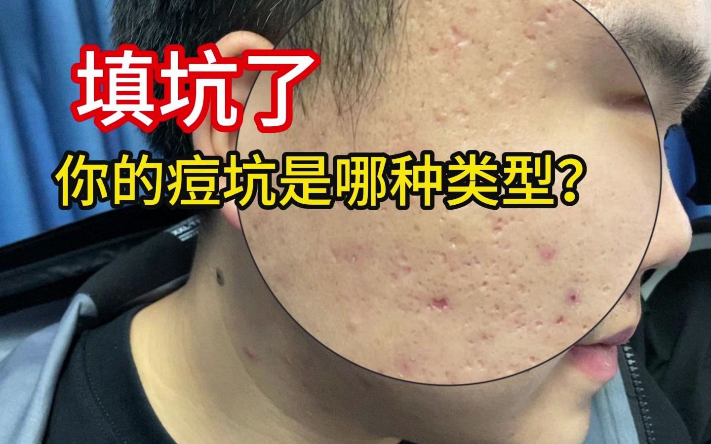 家人们谁懂啊,痘坑填得好,老婆回家早.新一期的填坑指南来了,内附详细的看诊记录,你知道自己是什么类型的痘坑吗?哔哩哔哩bilibili