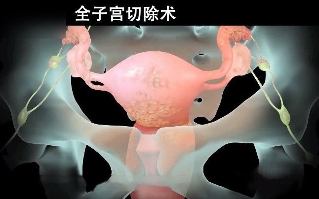 医生是如何操作机器人进行子宫切除手术的?3d动画演示全过程