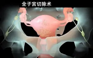 Download Video: 医生是如何操作机器人进行“子宫切除手术”的？3D动画演示全过程