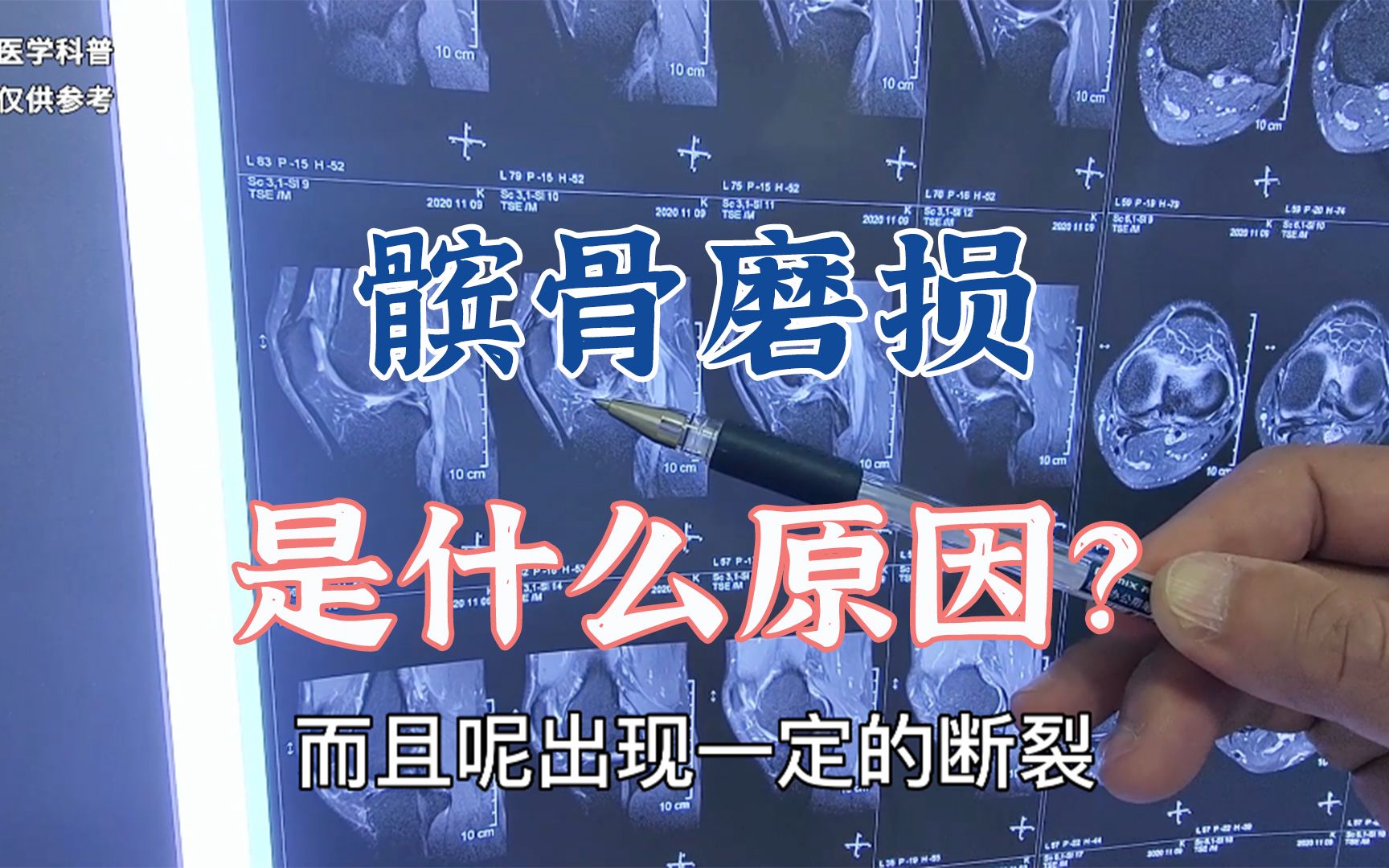 韧带损伤继发髌骨磨损导致产生疼痛,肖医生查体阅片分析病情哔哩哔哩bilibili