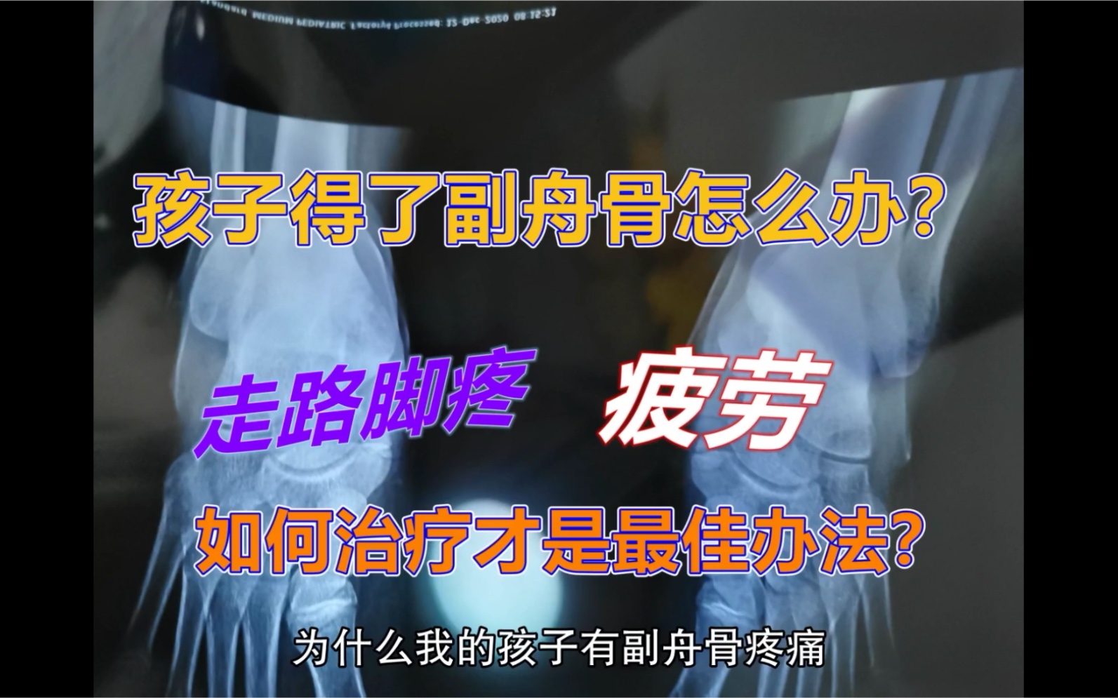 得了副舟骨疼痛怎么办?除了手术还有其他有效办法吗?医生科学讲解副舟骨的原因和矫正策略哔哩哔哩bilibili