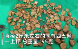 Télécharger la video: 看着都疼！男子膀胱内取出近200颗结石，在体内藏了十多年！