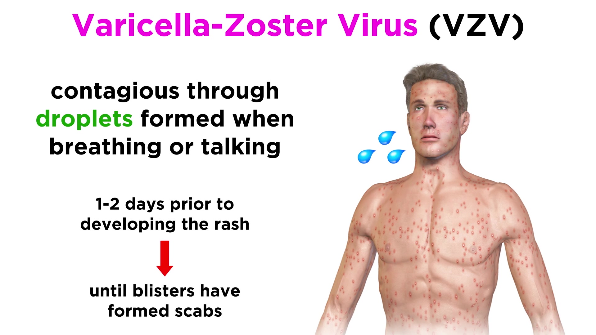 Chickenpox and Shingles (VaricellaZoster Virus)哔哩哔哩bilibili