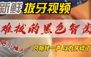 Download Video: 【商主任】大型拔牙现场，智齿都黑了，太难拔了，拔下来的瞬间差点以为智齿断了