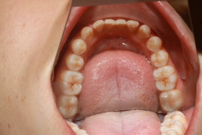 佛山前牙开合矫正一个月零五天