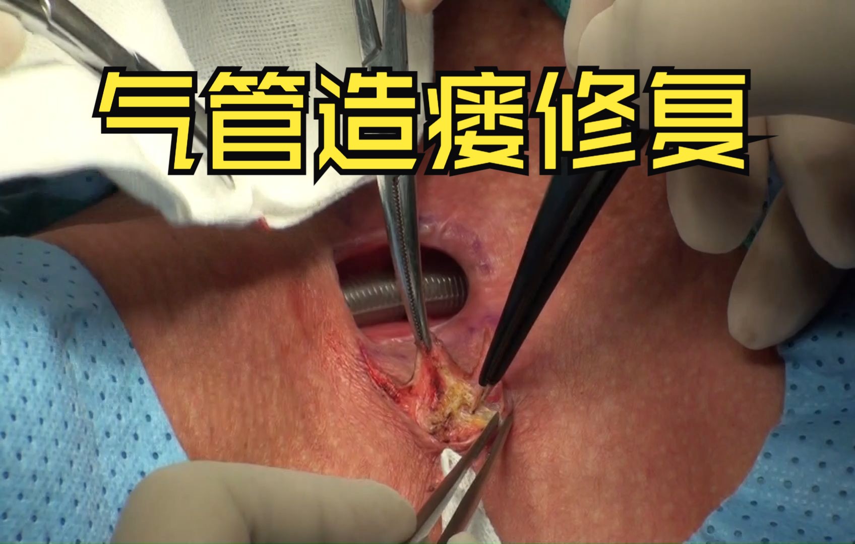 气管造瘘口修复术(翻转皮瓣,邻位转移皮瓣)附术后状态及发音情况-