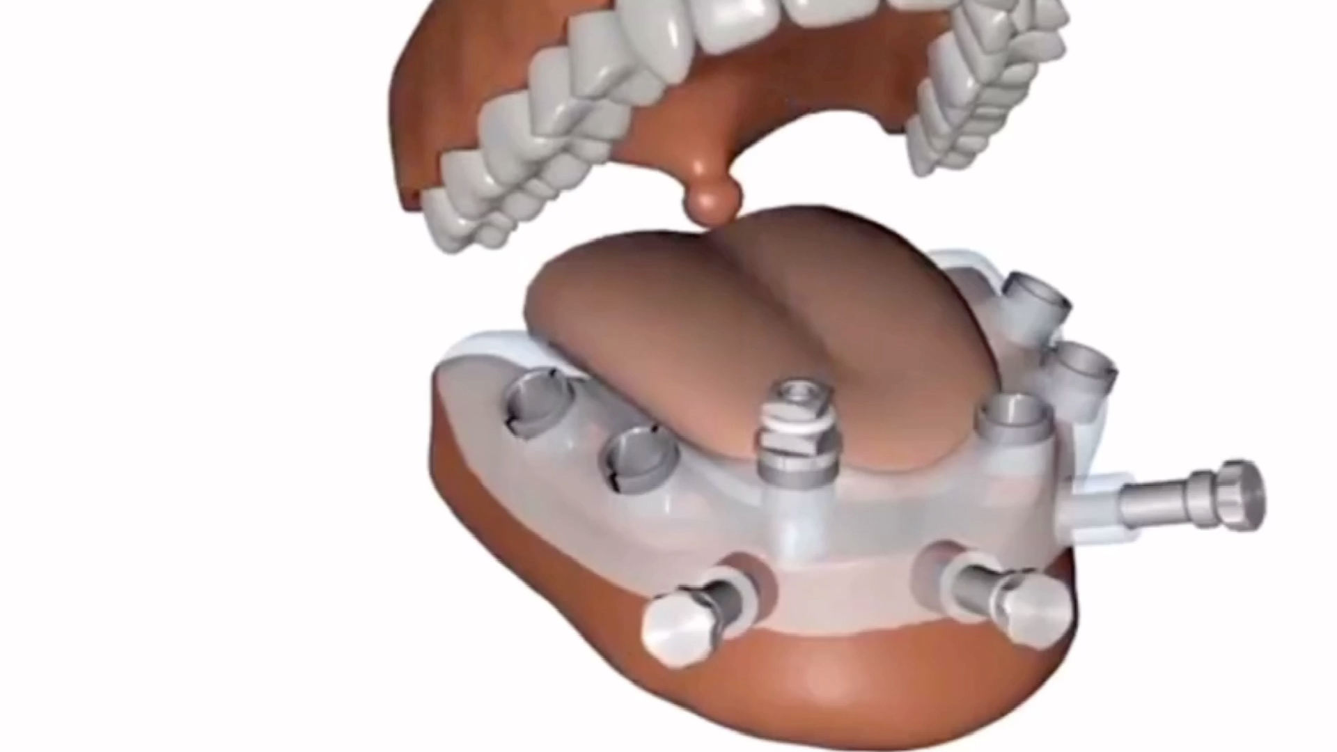 仅10分钟种一颗牙,无痛感的3d导板数字化种植牙来了_哔哩哔哩 (゜-゜)