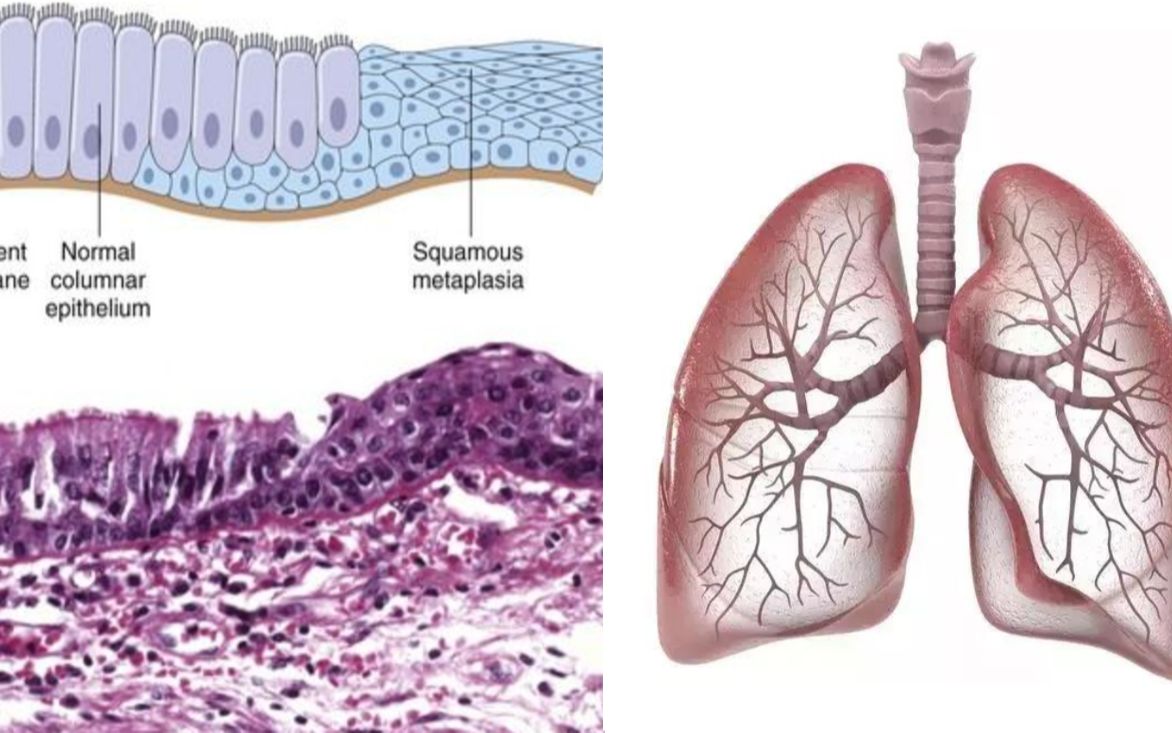 【小崔病理】27,支气管上皮及其鳞化(假复层纤毛柱状上皮转化为鳞状上皮)哔哩哔哩bilibili
