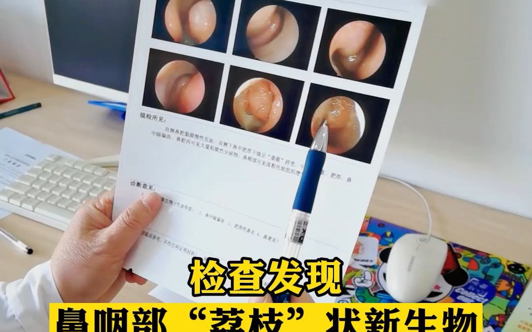 鼻咽部荔枝状新生物