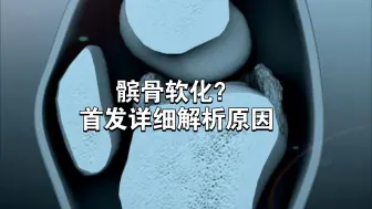 Tải video: 髌骨软化？首发解析详细原因！