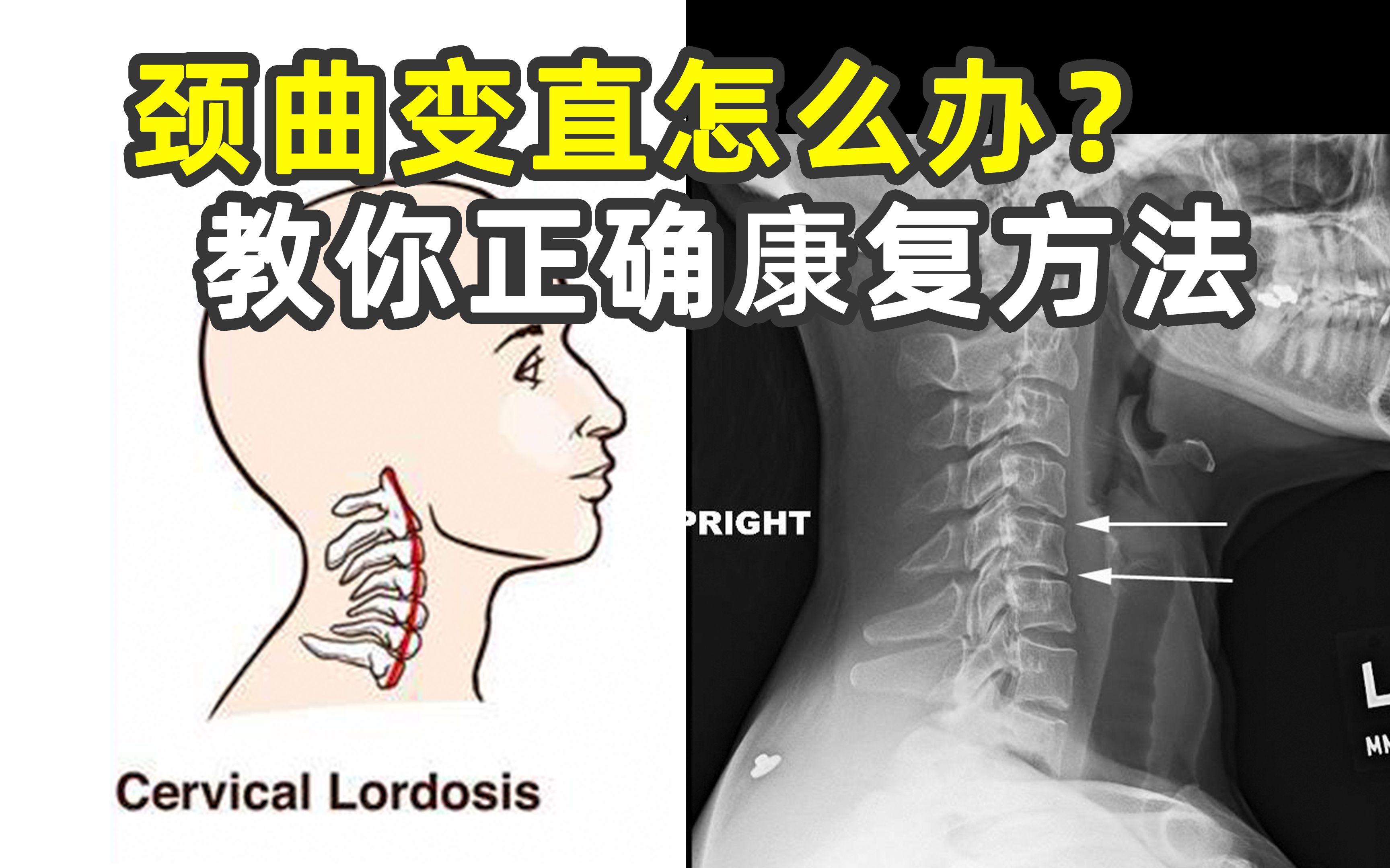 [图]颈椎曲度变直怎么办？康复师教你正确康复方法