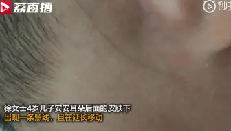 鱼鳞病儿童 皮肤以10倍的速度生长 寰球大百科177 哔哩哔哩 Bilibili