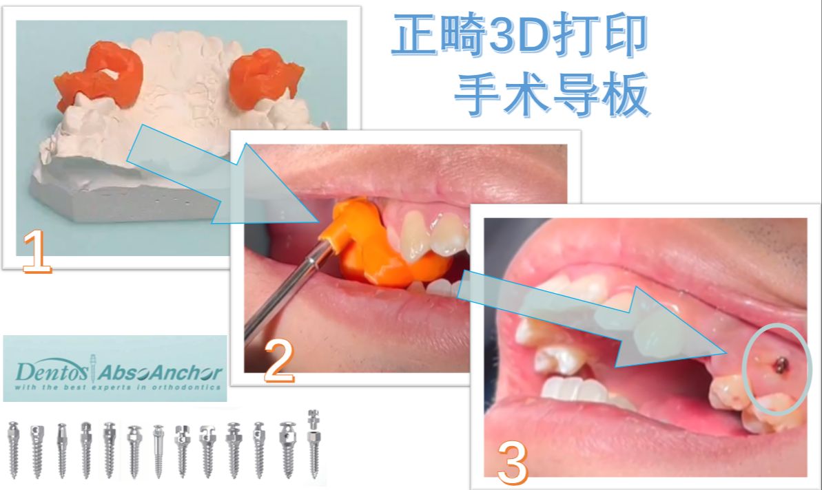 正畸3d打印微種植釘手術實操