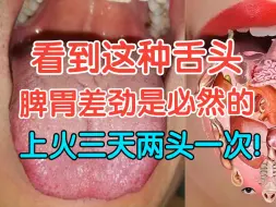 Tải video: 看到这种舌头，脾胃差劲是必然的，而上火三天两头一次