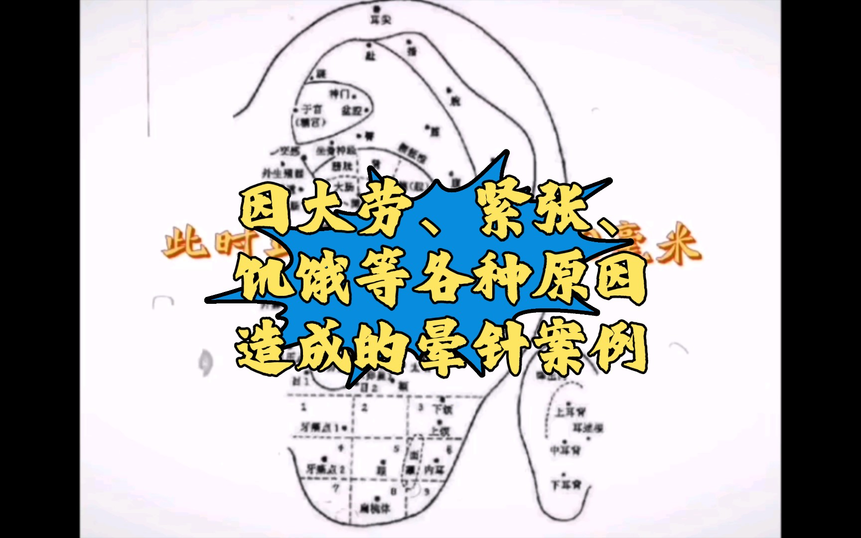 针灸意外及防治(四十二)因大劳、紧张、饥饿等各种原因造成的晕针案例哔哩哔哩bilibili