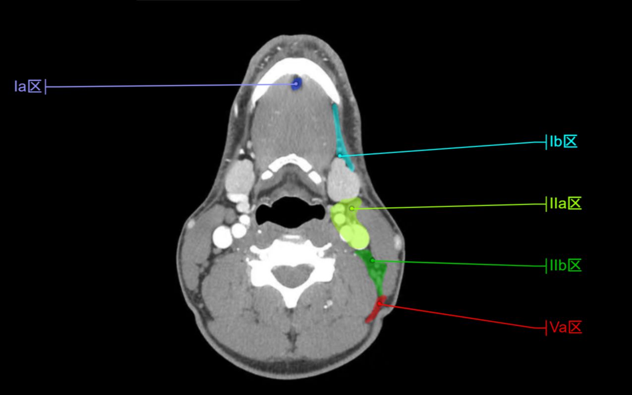 [图]恶性肿瘤诊断与治疗之头颈部淋巴结分区（上）