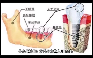 Download Video: 什么是植骨？为什么有些人用的到？