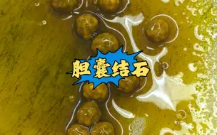 Video herunterladen: 黄色珍珠般的胆结石！胆结石最常见的诱因是早晨空腹使胆汁分泌减少，而胆固醇含量却没有改变，使胆固醇呈过饱和状态，很容易沉淀出来形成结石！所以大家一定记得要吃早饭！