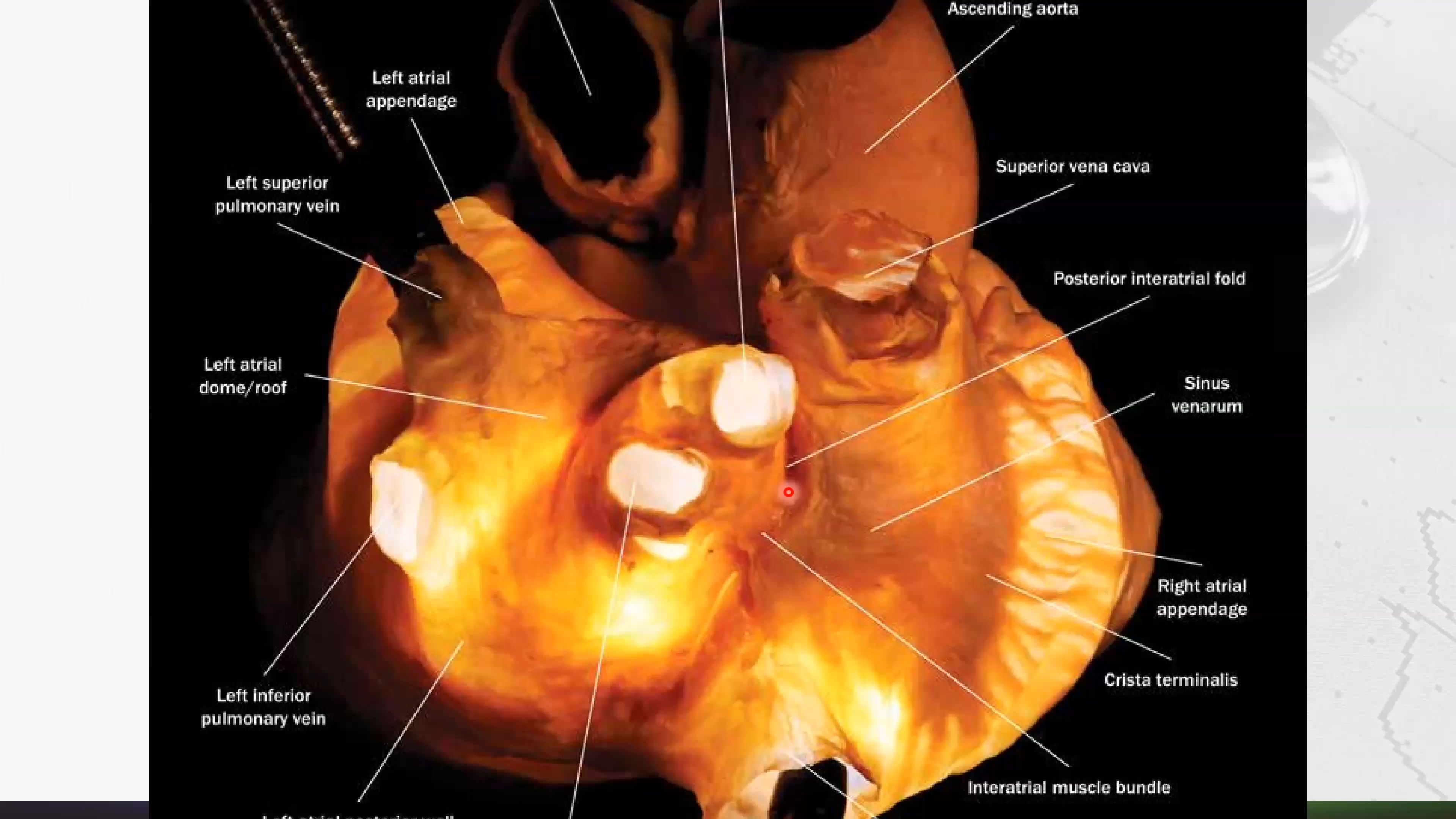 5 电生理视角打开《心脏解剖图册5静脉窦》哔哩哔哩bilibili