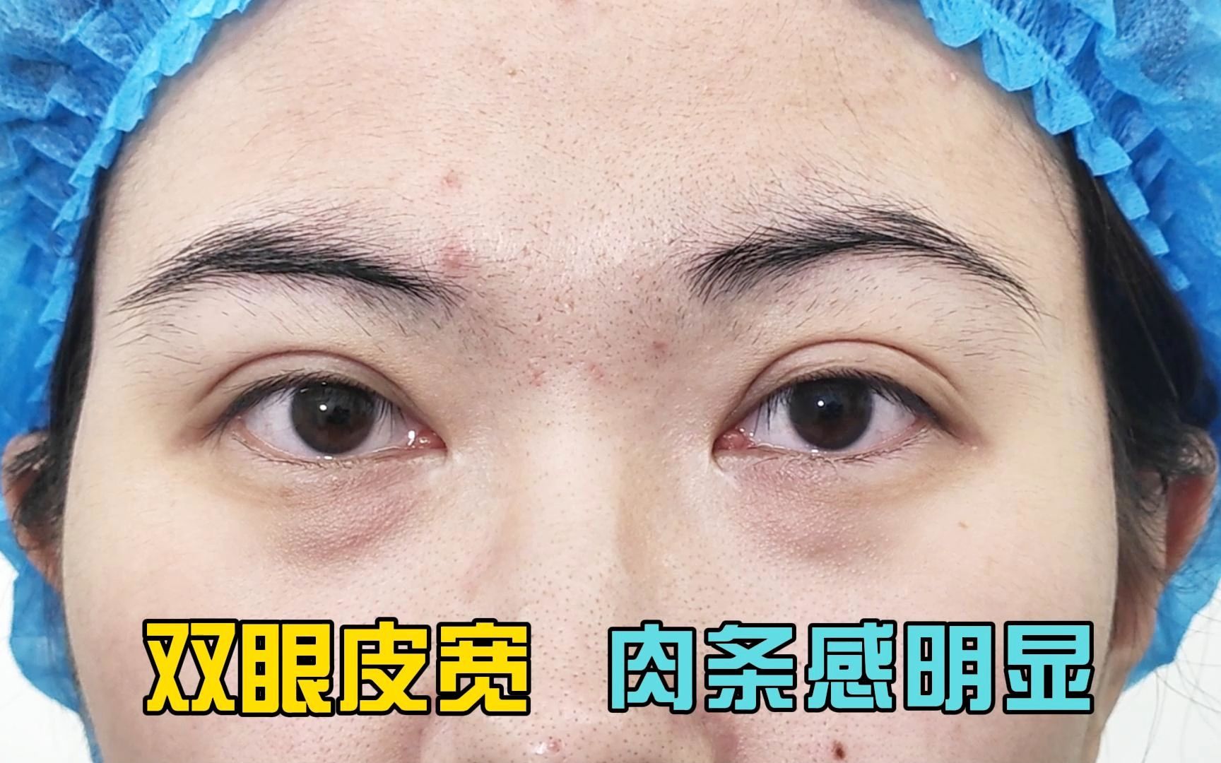双眼皮宽 不对称 肉条感明显 人工痕迹明显