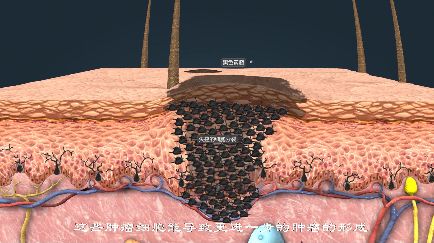 [图]黑色素瘤是一种非常致命的皮肤癌，皮肤癌也常常源于黑色素细胞中发生的突变 。