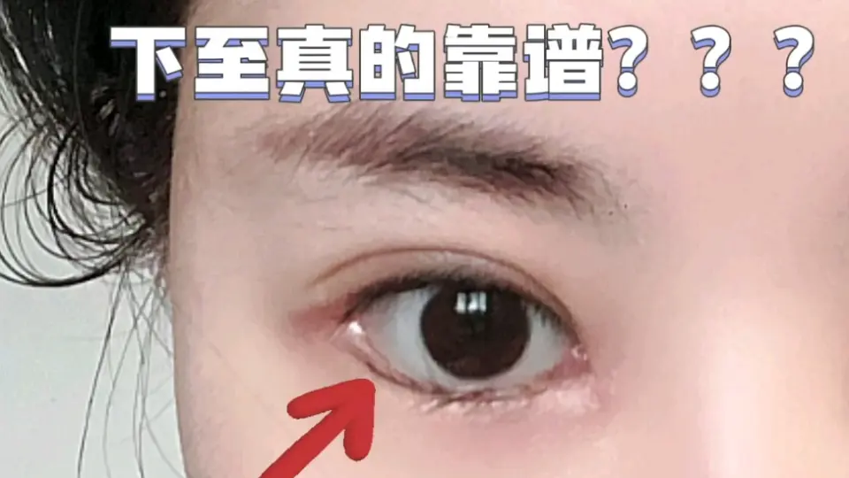 医学博士】竟然还有人做眼睑下至手术？可别瞎了！_哔哩哔哩_bilibili