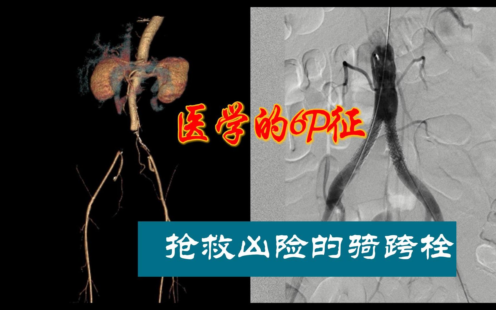 医学的6P征,一定要知道!| 抢救凶险的骑跨栓哔哩哔哩bilibili