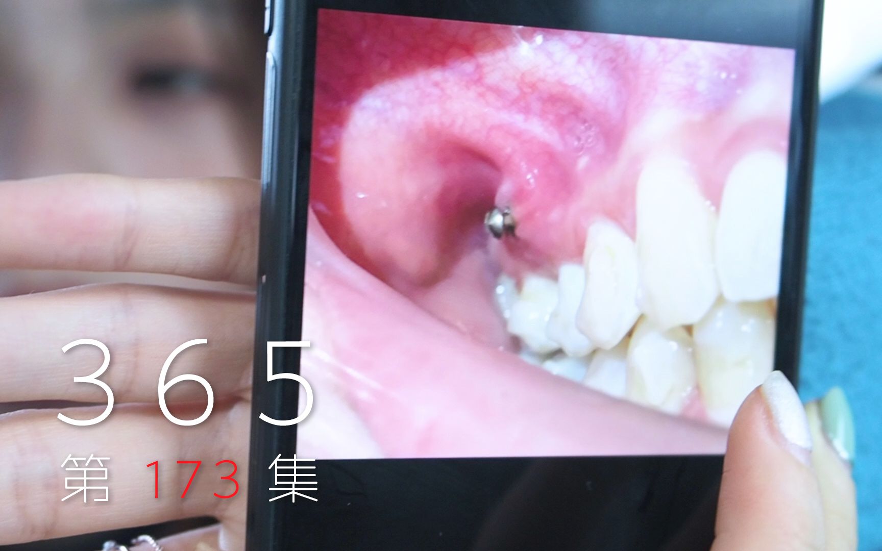 365vlog第173集丨我的骨钉处又发炎了上完药后顺便去看房