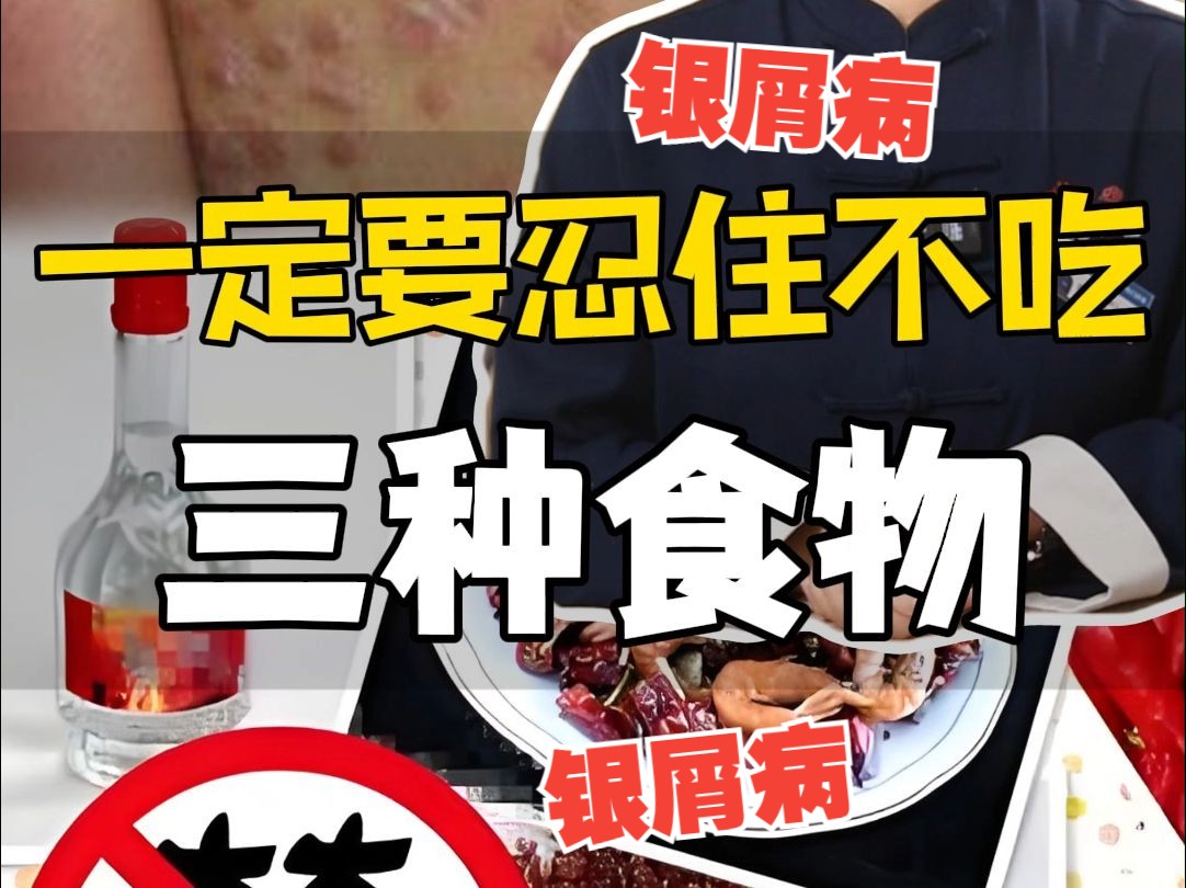 银屑病,三种食物不要吃